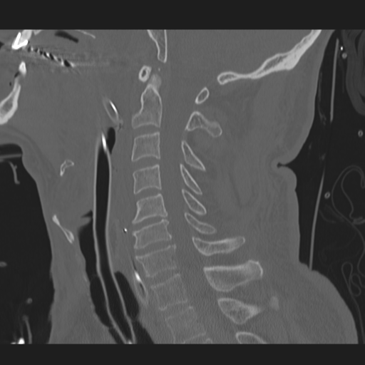 File:Occipital condyle fracture (Radiopaedia 33467-34517 Sagittal bone window 38).png