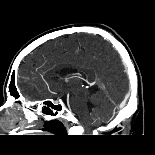 Occipital extradural hematoma simulating venous sinus thrombosis (Radiopaedia 46514-50964 D 38).jpg