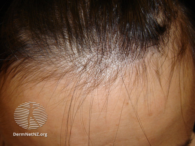 File:Telogen effluvium regrowth is best seen at the hairline (DermNet NZ hair-nails-sweat-drug-alopecia3).jpg