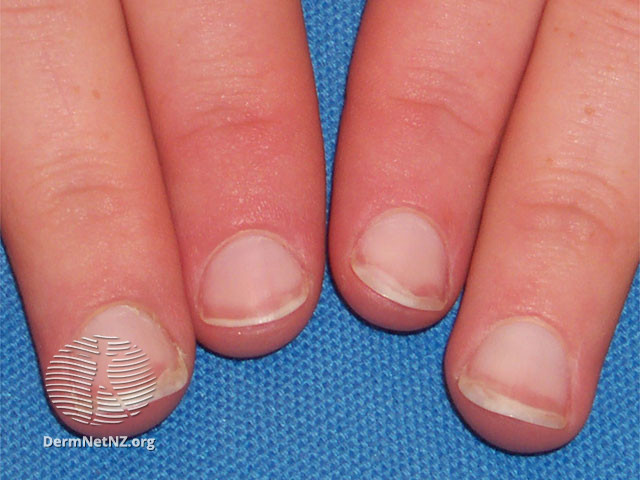 File:Terry nails (DermNet NZ terry-nails-0).jpg