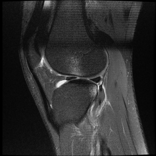 File:ACL acute full thickness tear - deep lateral femoral sulcus sign (Radiopaedia 38594-40740 Sagittal PD fat sat 16).jpg