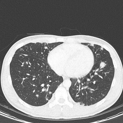 AIDS-related Kaposi sarcoma (Radiopaedia 85247-100811 Axial lung window 117).jpg