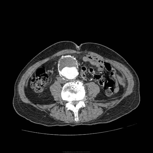 Abdominal aortic aneurysm (Radiopaedia 13341-13340 Axial C+ arterial phase 133).jpg
