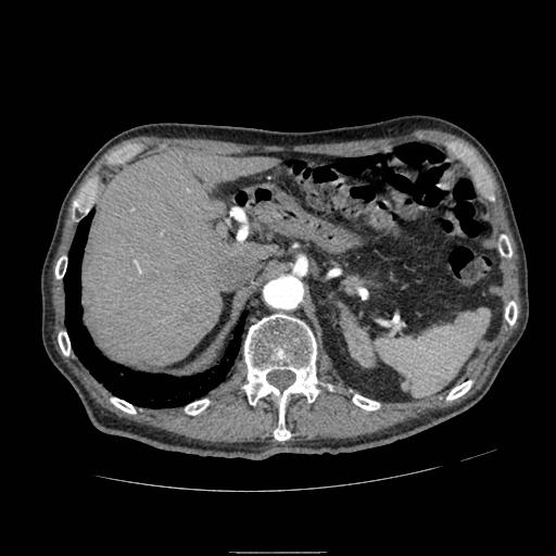 Abdominal aortic aneurysm (Radiopaedia 13341-13340 Axial C+ arterial phase 40).jpg