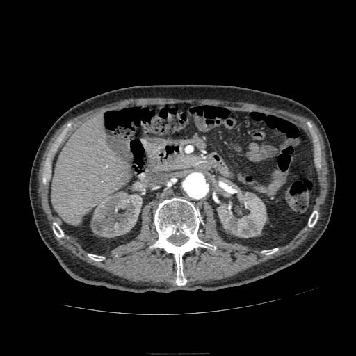 Abdominal aortic aneurysm (Radiopaedia 13341-13340 Axial C+ arterial phase 74).jpg
