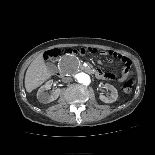 Abdominal aortic aneurysm (Radiopaedia 13341-13340 Axial C+ arterial phase 84).jpg