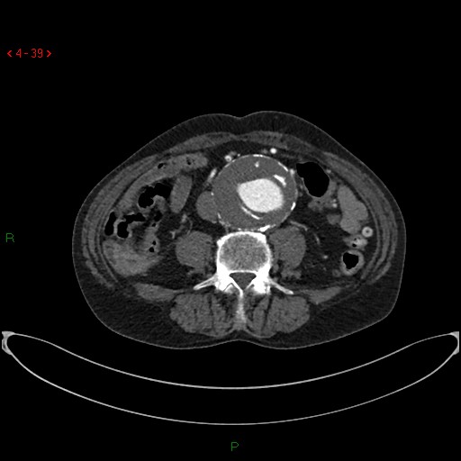 File:Abdominal aortic aneurysm (Radiopaedia 16155-15834 Axial C+ arterial phase 19).jpg