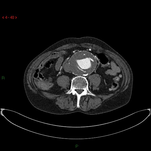 File:Abdominal aortic aneurysm (Radiopaedia 16155-15834 Axial C+ arterial phase 20).jpg
