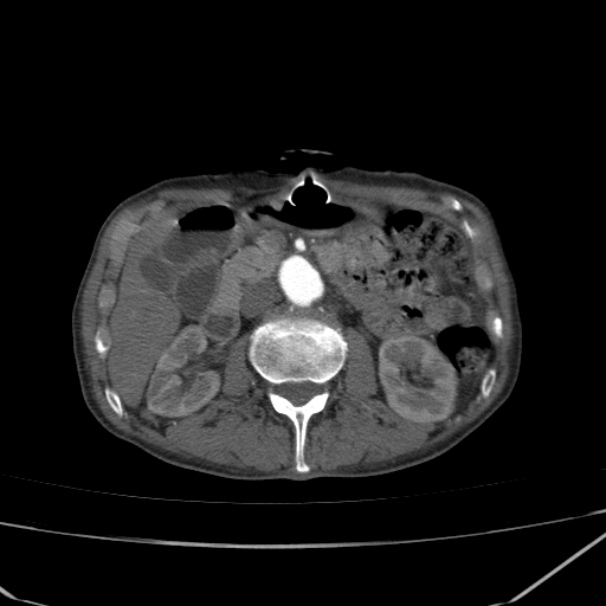 Abdominal aortic aneurysm (Radiopaedia 23703-23856 Axial C+ arterial phase 31).jpg