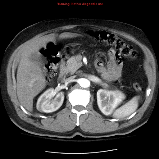 Abdominal aortic aneurysm (Radiopaedia 8190-9038 Axial C+ arterial phase 29).jpg