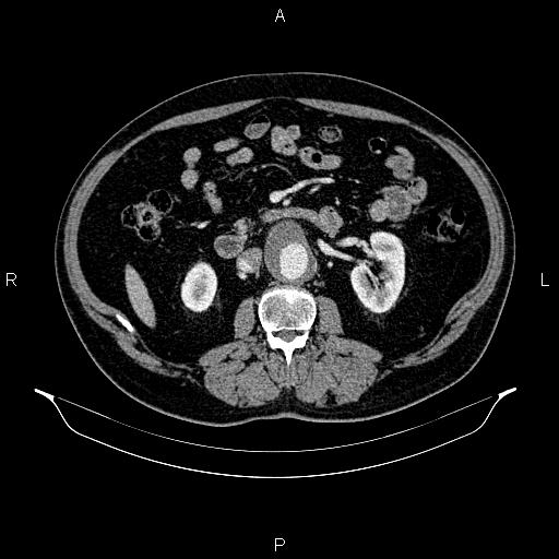Abdominal aortic aneurysm (Radiopaedia 83094-97462 Axial renal cortical phase 95).jpg