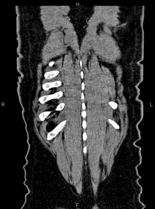 Abdominal aortic aneurysm (Radiopaedia 83094-97462 Coronal renal cortical phase 86).jpg