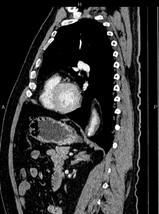 Abdominal aortic aneurysm (Radiopaedia 83094-97462 Sagittal renal cortical phase 79).jpg