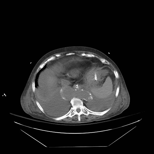Abdominal aortic aneurysm - impending rupture (Radiopaedia 19233-19247 Axial non-contrast 30).jpg