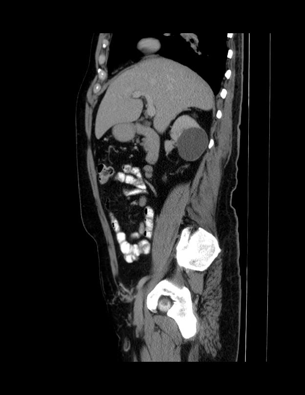 Abdominal lymphoma - with sandwich sign (Radiopaedia 53486-59492 Sagittal C+ portal venous phase 53).jpg