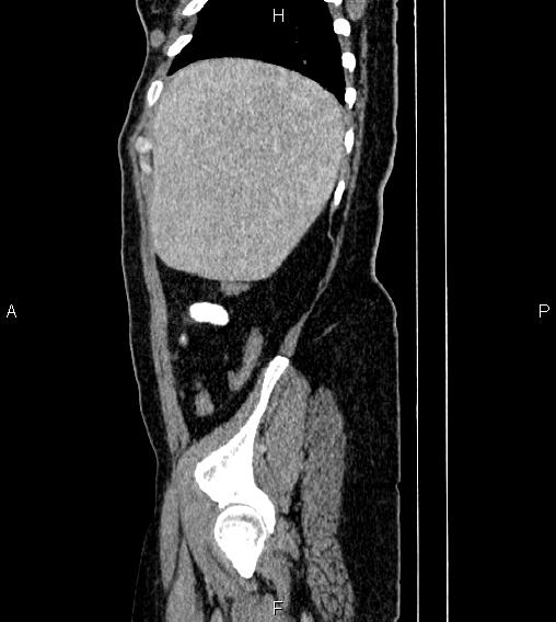 File:Abdominal lymphoma with sandwich sign (Radiopaedia 84378-99704 Sagittal C+ portal venous phase 79).jpg