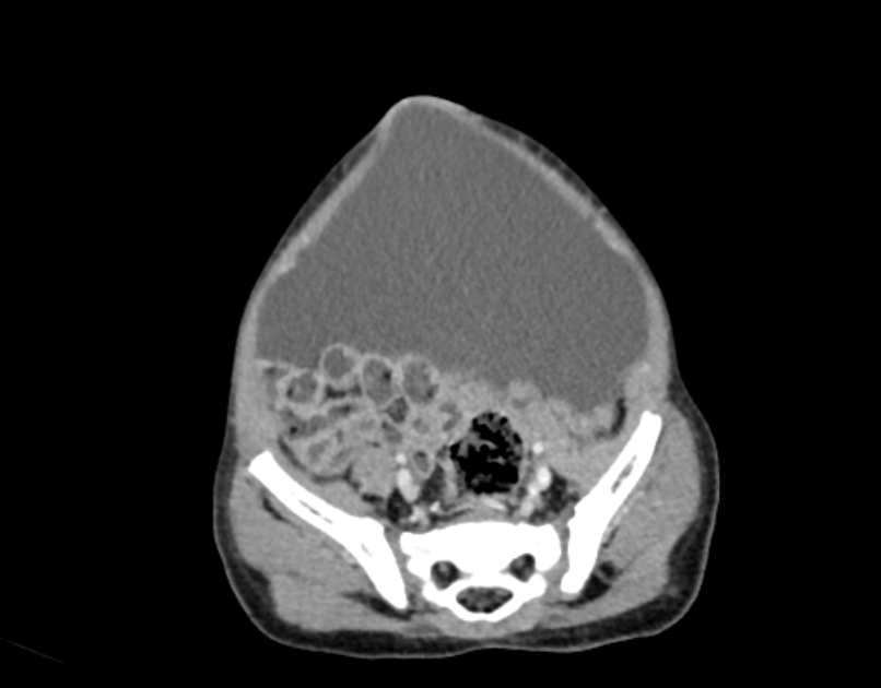 Abdominal premesenteric cystic lymphangioma (Radiopaedia 82995-97350 Axial C+ portal venous phase 52).jpg