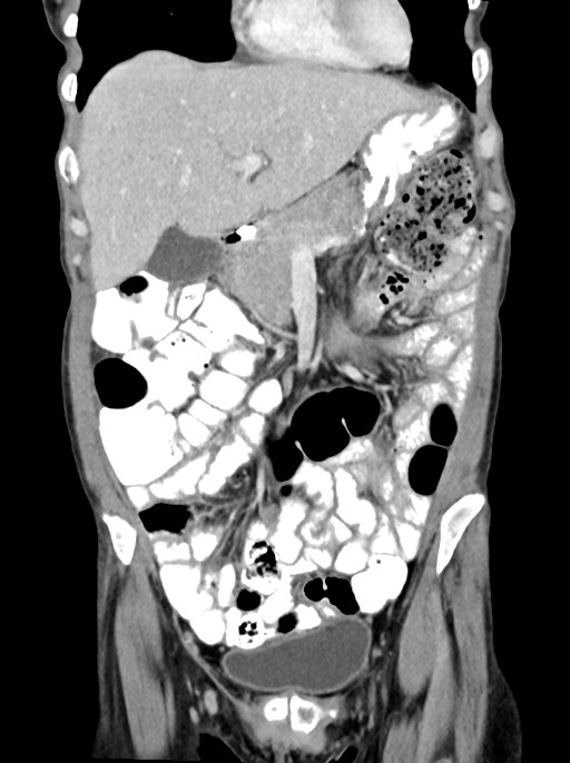 Abdominal wall and retroperitoneal tuberculosis (Radiopaedia 88137-104729 Coronal C+ portal venous phase 31).jpg