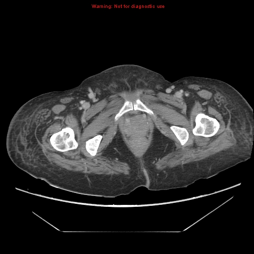 File:Abdominal wall hematoma (Radiopaedia 9427-10112 Axial C+ portal venous phase 111).jpg