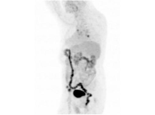 File:Abdominal wall metastasis from colorectal carcinoma (Radiopaedia 31016-31719 Rotational MIP 12).jpg