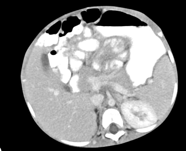 Abdominopelvic rhabdomyosarcoma (Radiopaedia 78356-90984 Axial C+ portal venous phase 61).jpg