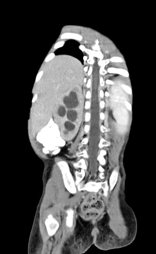 Abdominopelvic rhabdomyosarcoma (Radiopaedia 78356-90984 Coronal C+ portal venous phase 75).jpg