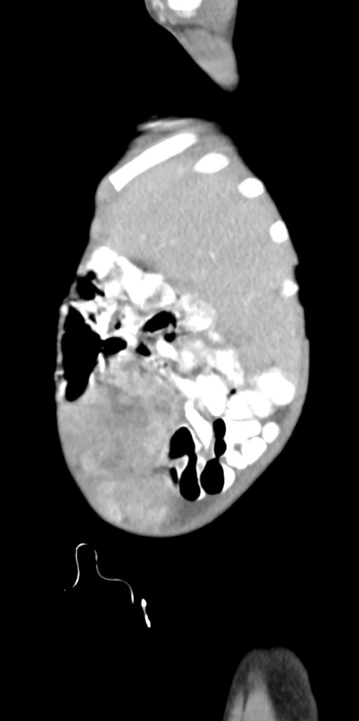 Abdominopelvic rhabdomyosarcoma (Radiopaedia 78356-90984 Sagittal C+ portal venous phase 88).jpg
