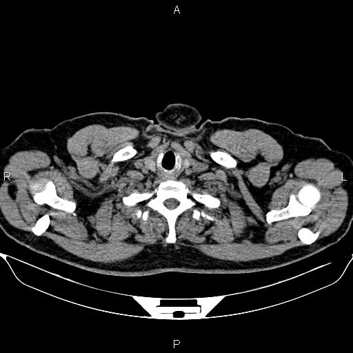 Aberrant right subclavian artery (Radiopaedia 87093-103354 Axial non-contrast 3).jpg