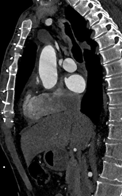 Accessory left atrial appendage (Radiopaedia 81987-95968 Sagittal C+ arterial phase 30).jpg