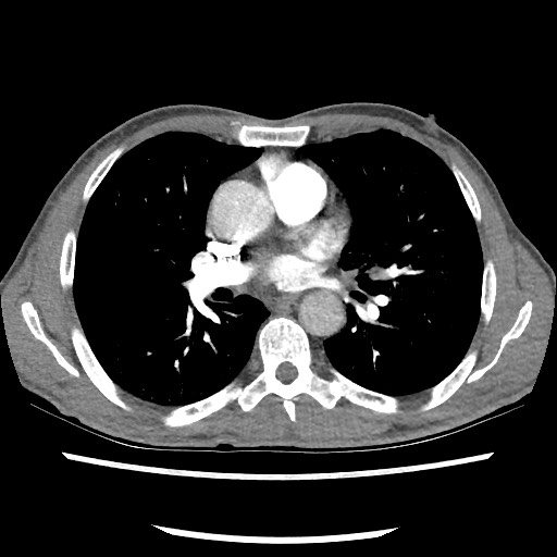 Accessory left horizontal fissure with lingular pneumonia (Radiopaedia 53763-59843 Axial C+ CTPA 49).jpg