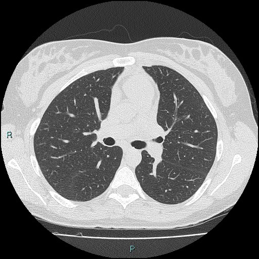 File:Accidental foreign body aspiration (seamstress needle) (Radiopaedia 77740-89983 Axial lung window 28).jpg