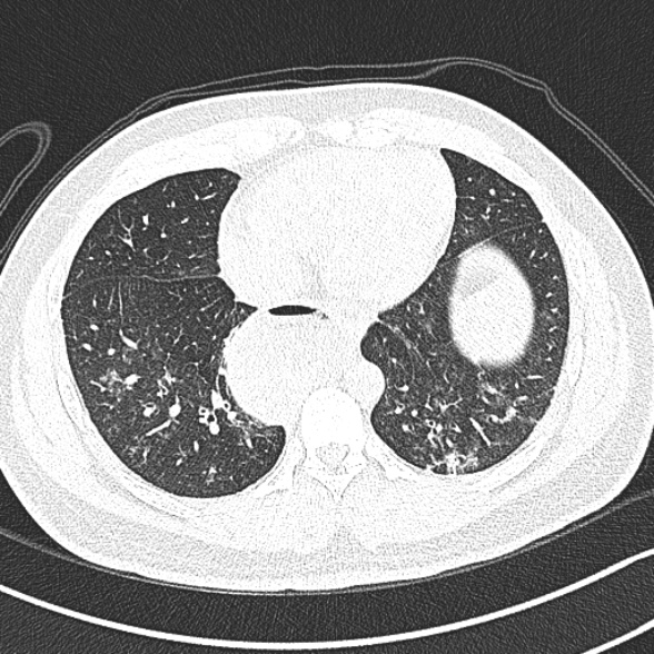 Achalasia with aspiration (Radiopaedia 55413-61845 Axial lung window 54).jpg
