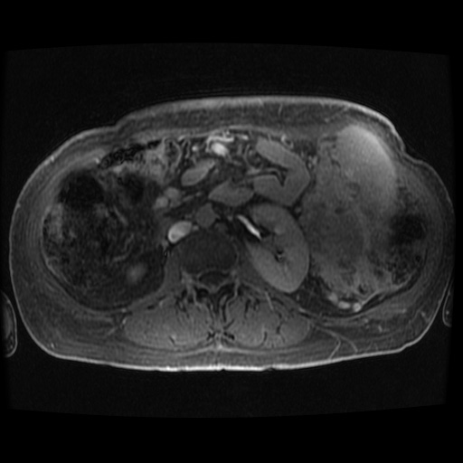 Acinar cell carcinoma of the pancreas (Radiopaedia 75442-86668 Axial late phase (~30 mins) 20).jpg