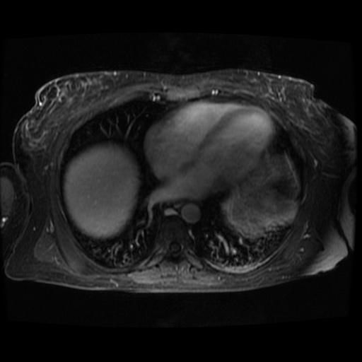 Acinar cell carcinoma of the pancreas (Radiopaedia 75442-86668 D 140).jpg