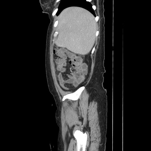 Acinar cell carcinoma of the pancreas (Radiopaedia 75442-86669 Sagittal C+ portal venous phase 42).jpg