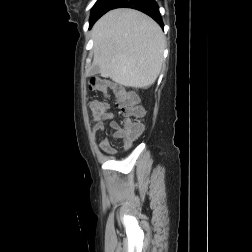 File:Acinar cell carcinoma of the pancreas (Radiopaedia 75442-86669 Sagittal C+ portal venous phase 46).jpg