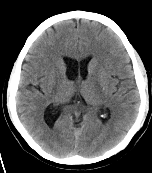 File:Acoustic schwannoma (Radiopaedia 33045-34065 Axial non-contrast 14).png