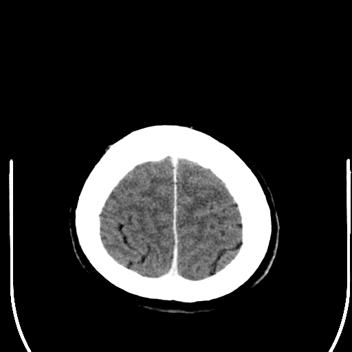 File:Acoustic schwannoma (Radiopaedia 39170-41389 Axial C+ 26).png