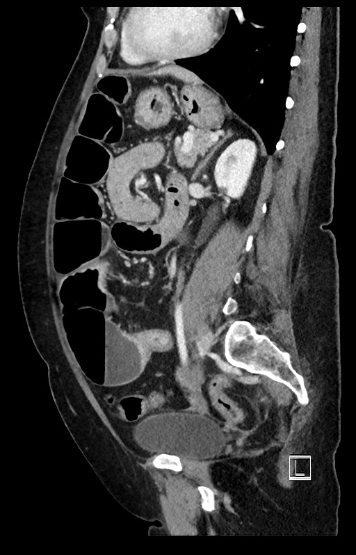 Active Crohn disease (Radiopaedia 59394-66750 Sagittal C+ portal venous phase 22).jpg