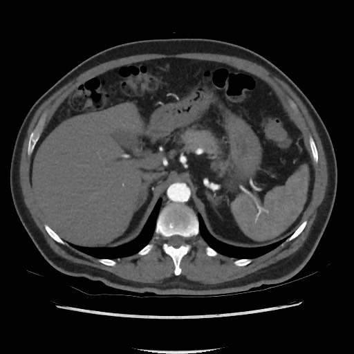 File:Active colonic bleed on CT (Radiopaedia 49765-55025 Axial C+ arterial phase 22).jpg