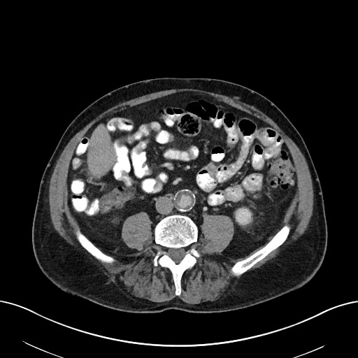File:Active lower gastrointestinal bleeding - diverticular (Radiopaedia 61203-69106 Axial C+ portal venous phase 74).jpg