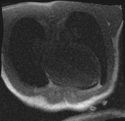 File:Active right ventricular cardiac sarcoidosis (Radiopaedia 55596-62100 Axial Dynamic perfusion scan MOCO 1).jpg