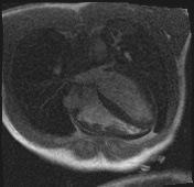 File:Active right ventricular cardiac sarcoidosis (Radiopaedia 55596-62100 Axial Dynamic perfusion scan MOCO 39).jpg