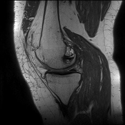 Acute-on-chronic transient lateral patellar dislocation with trochlear dysplasia (Radiopaedia 84099-99349 Sagittal PD 64).jpg