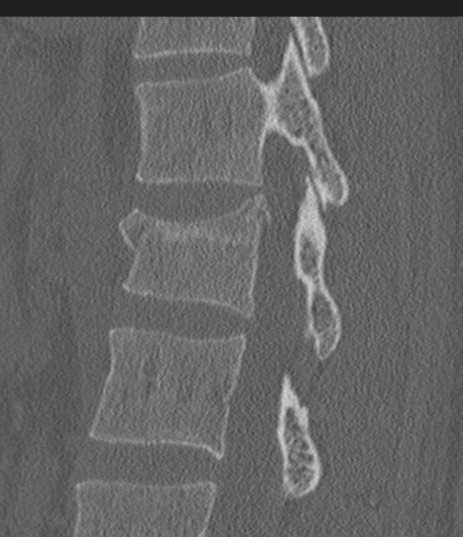 Acute L1 burst compression fracture (Radiopaedia 34430-35755 Sagittal bone window 39).png