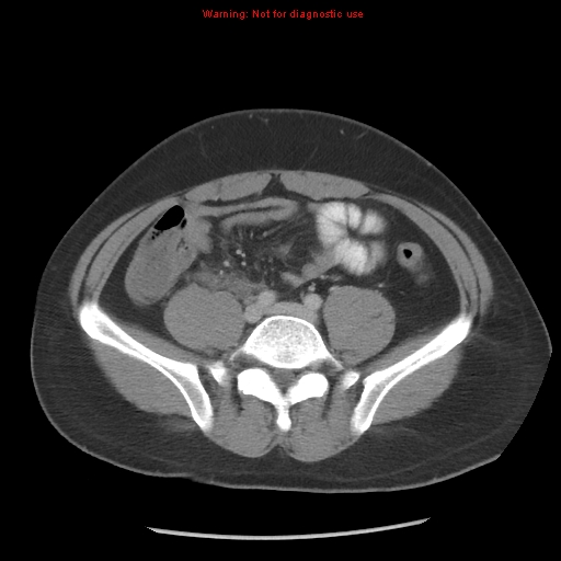 Acute appendicitis (Radiopaedia 10498-10973 Axial C+ portal venous phase 20).jpg