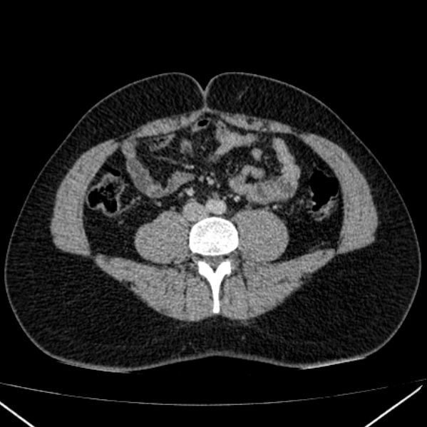 Acute appendicitis (Radiopaedia 38255-40270 Axial C+ portal venous phase 64).jpg