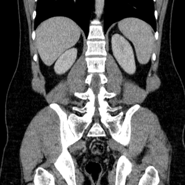 File:Acute appendicitis (Radiopaedia 38255-40270 Coronal C+ portal venous phase 62).jpg