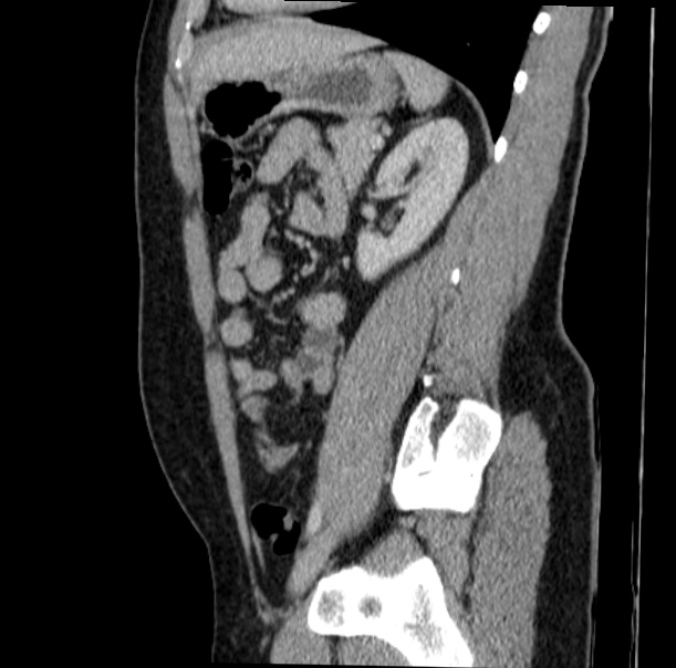 Acute appendicitis (Radiopaedia 38255-40270 Sagittal C+ portal venous phase 56).jpg
