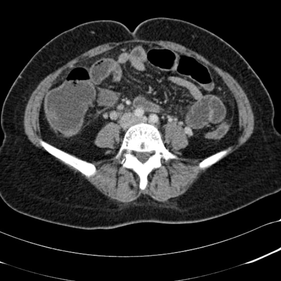 Acute appendicitis (Radiopaedia 48792-53822 Axial C+ portal venous phase 70).jpg